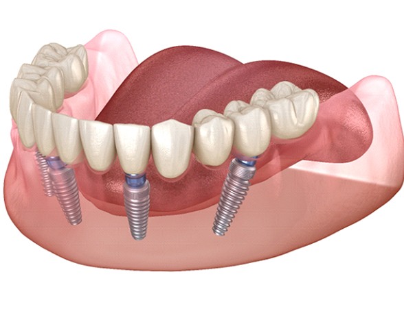 diagram showing All-On-4 dental implants in Pacoima