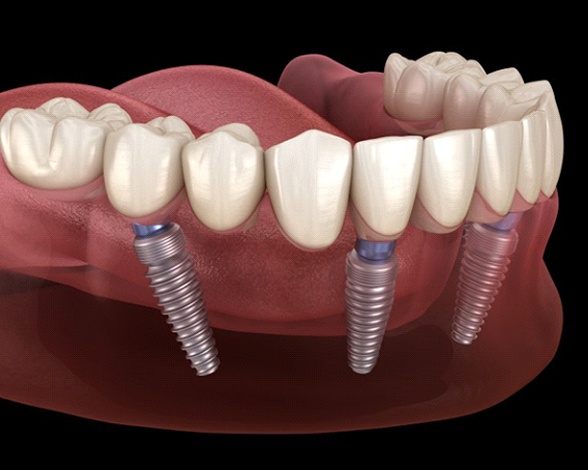 Digital illustration on dark background of All-On-4 dental implants in Pacoima