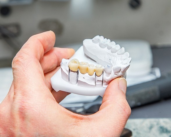 Dental bridge in Pacoima on a clay model