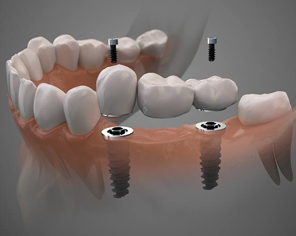 Digital illustration of implant bridge in Pacoima