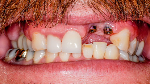 Yellowed and decayed teeth before cosmetic dentistry