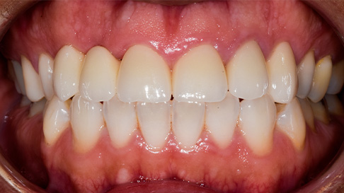 Healthy white smile after cosmetic dentistry