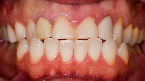 Yellowed and decayed teeth before cosmetic dentistry