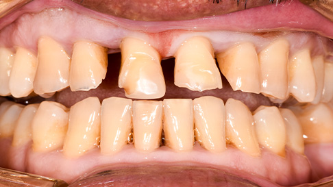 Yellowed and decayed teeth before cosmetic dentistry