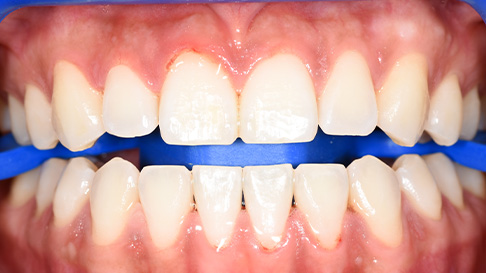 Healthy white smile after cosmetic dentistry