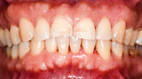 Yellowed and decayed teeth before cosmetic dentistry