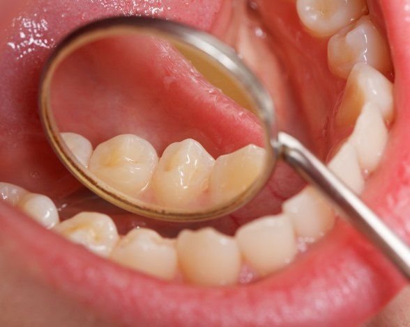 Dentist examining smile after metal free dental crown restoration