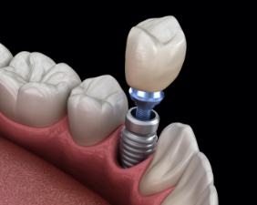 Animated smile during dental implant supported dental crown placement