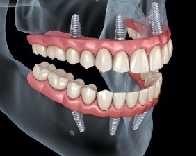 Animated smile during dental implant supported fixed bridge placement