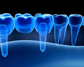 X-ray illustration of a dental bridge in Pacoima