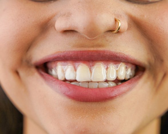 Closeup of patient smiling while wearing Invisalign aligner