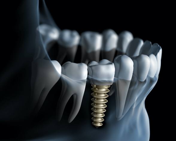 Animated smile with dental implant supported dental crown