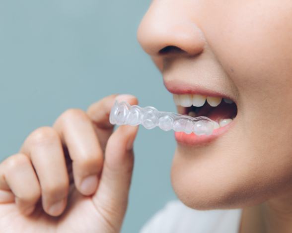 Patient placing Invisalign clear braces orthodontics tray