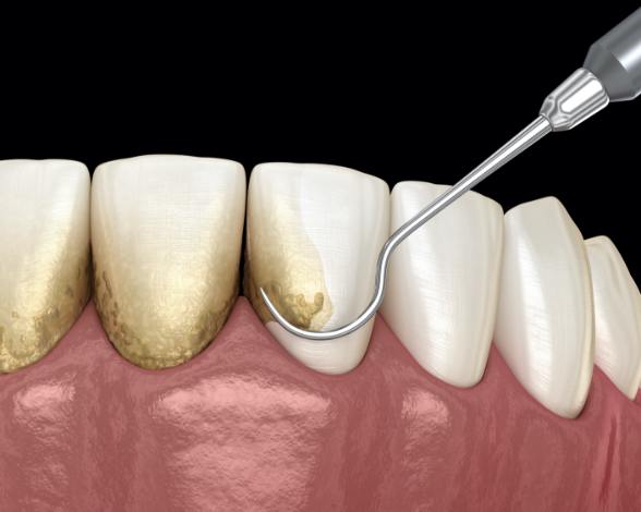 Animated smile during scaling and root planing periodontal therapy