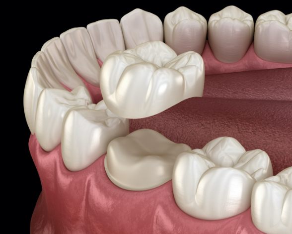 Animated smile during dental crown restoration