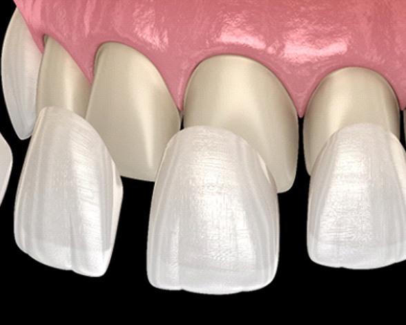 Pacoima veneers 3D illustration
