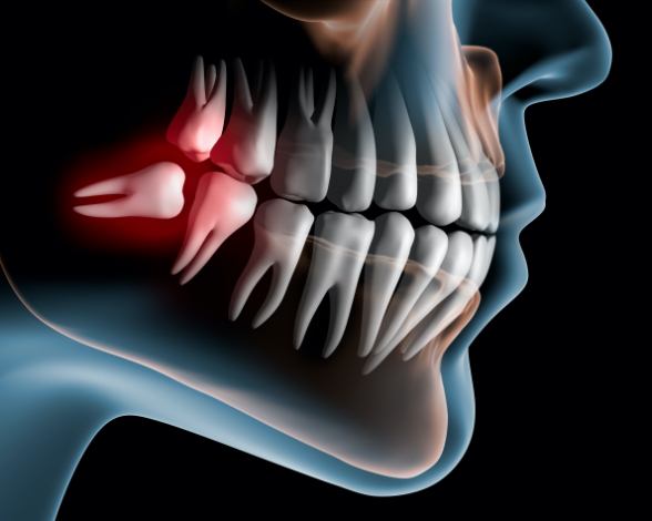 Animated smile with impacted wisdom teeth in need of extraction