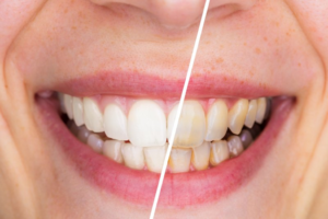 a before/after comparison of teeth whitening  