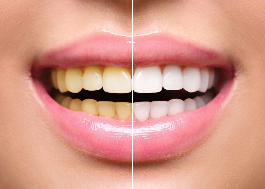 A woman’s smile before and after professional whitening treatment